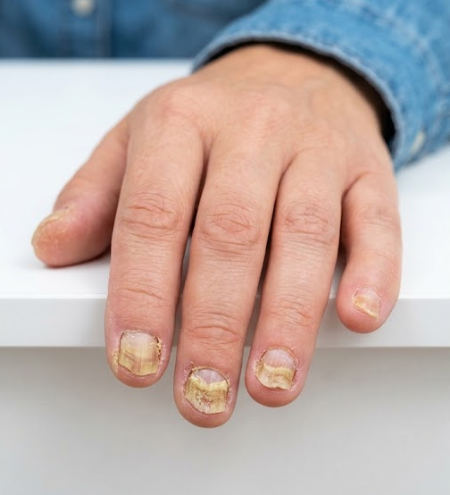 Antes